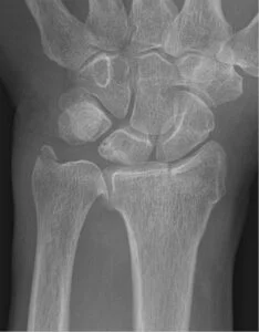 Chauffeur Fracture