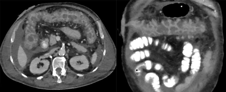 CT showing Pseudomembranous Colitis