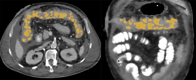CT with annotation highlighting Pseudomembranous Colitis