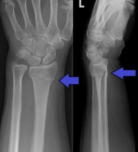 Colles with Ulnar Styloid Fracture