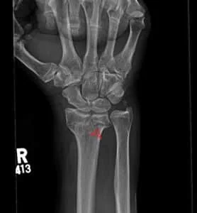 Die Punch Fracture