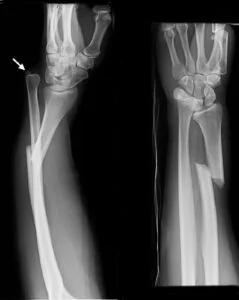 X-ray of Galeazzi fracture-dislocation (dorsal dislocation)