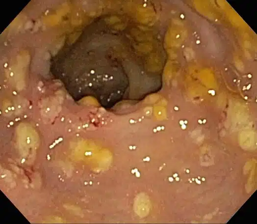 Colonoscopy images of pseudomembranous colitis