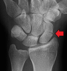x ray of scaphoid fracture