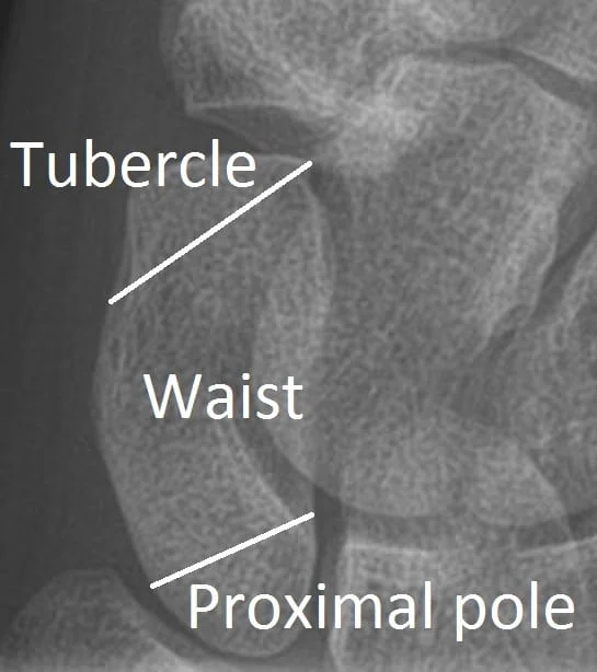 X ray showing Scaphoid Fracture Classification anatomy