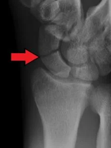 x ray of scaphoid fracture