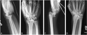 Dorsal Bartons Fracture