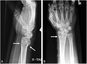 Colles Fracture