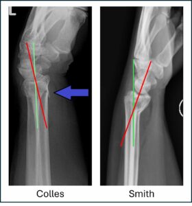 Colles vs Smith fracture comparison