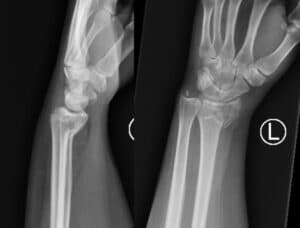 Smith Fracture